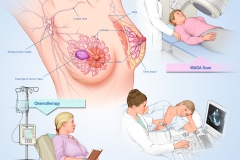 Breast cancer anatomy, imaging and treatment