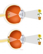 Refraction in nearsighted and farsighted eyes
