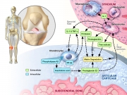 Catabolic environment of osteoarthritic knee joint