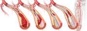Thrombolytic options