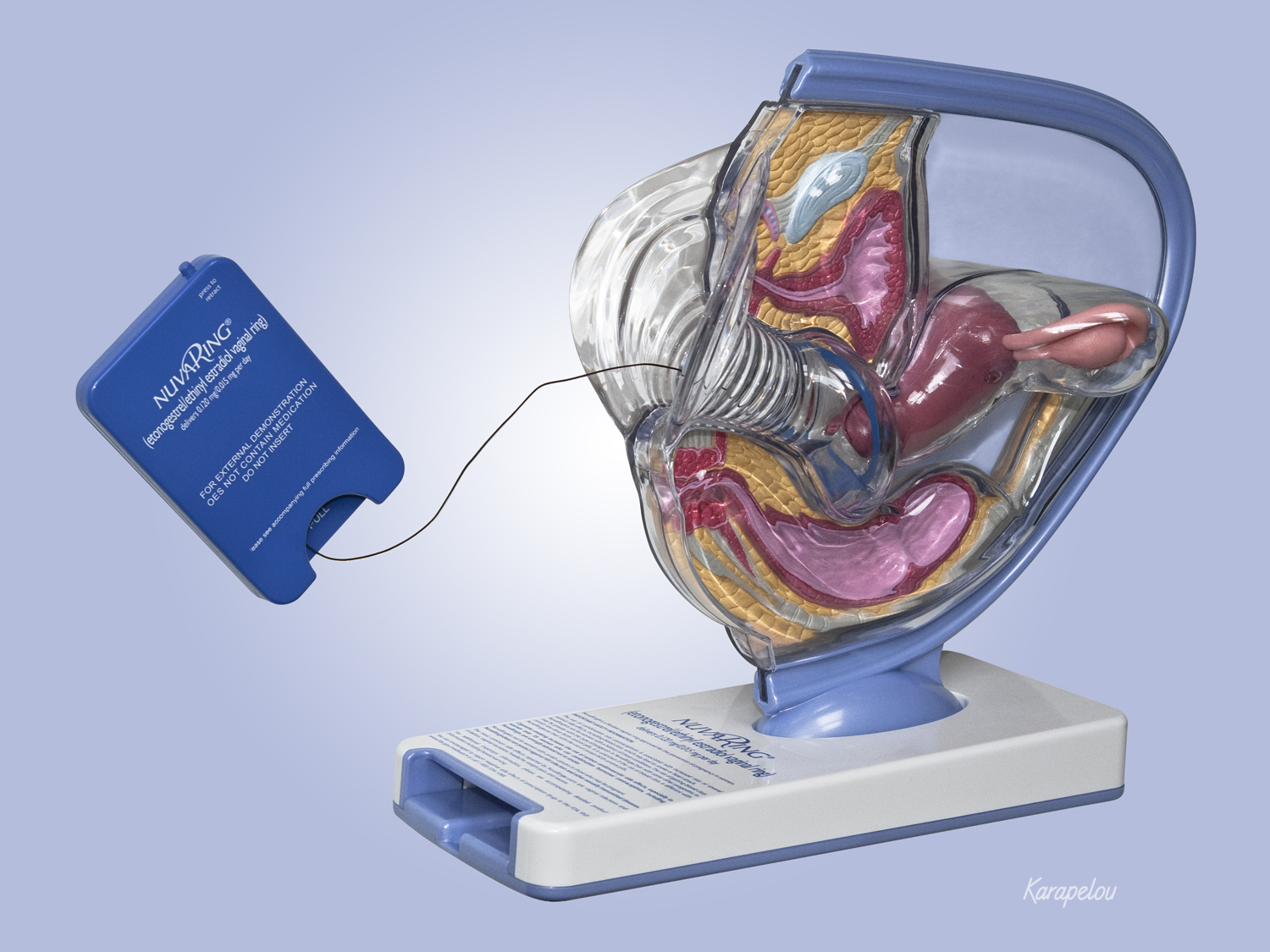 Anatomical model for demonstration of NuvaRing contraceptive product. Anatomical design by John W. Karapelou, CMI